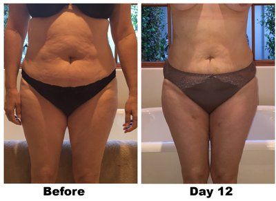 Quá trình hút mỡ căng mô ở bụng, hai bên sườn và hai bên đùi trong của bà mẹ 53 tuổi