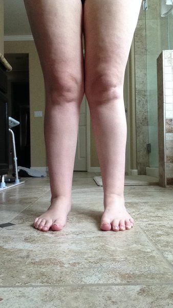 Mẹ 3 con quyết tâm hút mỡ đùi, bắp chân và mắt cá chân