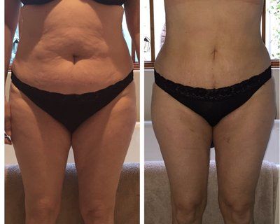 Quá trình hút mỡ căng mô ở bụng, hai bên sườn và hai bên đùi trong của bà mẹ 53 tuổi