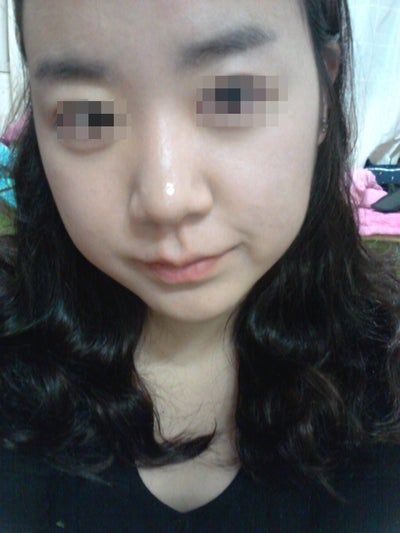 Hành trình hút mỡ má và cằm đôi tạm biệt khuôn mặt mũm mĩm của cô gái 23 tuổi