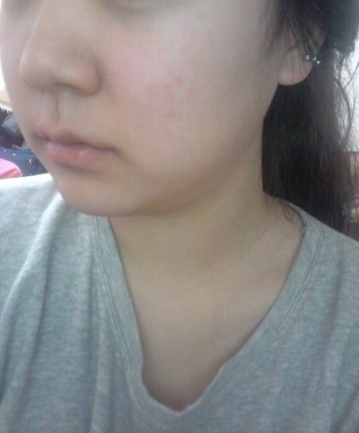 Hành trình hút mỡ má và cằm đôi tạm biệt khuôn mặt mũm mĩm của cô gái 23 tuổi