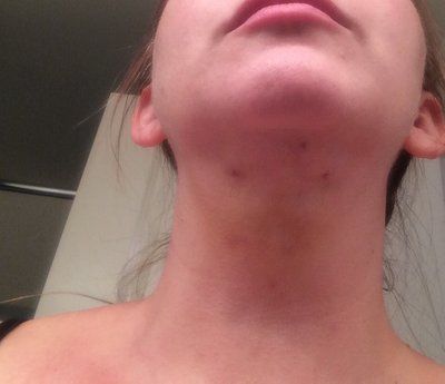 40 tuổi với hành trình loại bỏ cằm ngấn mỡ di truyền
