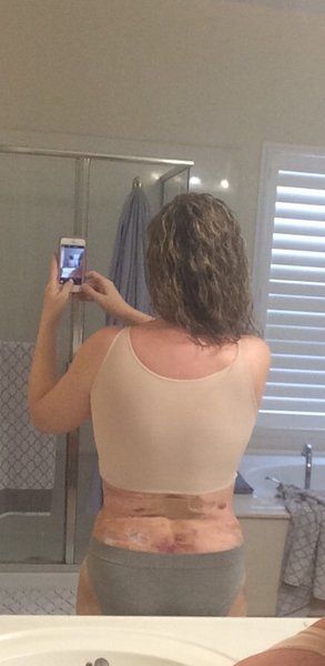 Cùng theo dõi quá trình hút bỡ hai bên hông, sườn và lưng của bà mẹ 46 tuổi