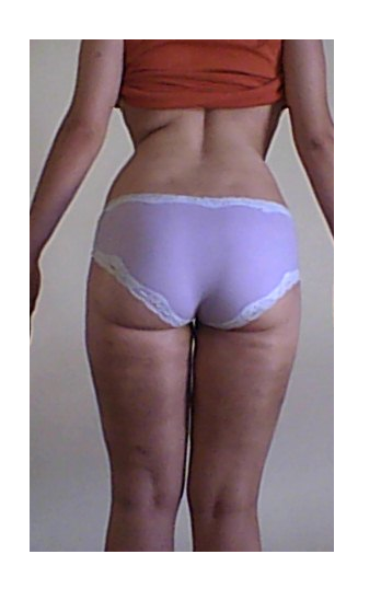 Hành trình hút mỡ đùi trong và xử lý vùng da sần vỏ cam