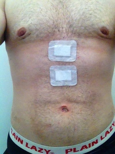 Điêu khắc tạo hình vùng bụng và ngực với kỹ thuật hút mỡ Vaser Hi Def của quý ông bị chứng vú to (Gynecomastia)