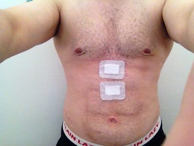 Điêu khắc tạo hình vùng bụng và ngực với kỹ thuật hút mỡ Vaser Hi Def của quý ông bị chứng vú to (Gynecomastia)