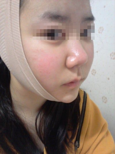Hành trình hút mỡ má và cằm đôi tạm biệt khuôn mặt mũm mĩm của cô gái 23 tuổi