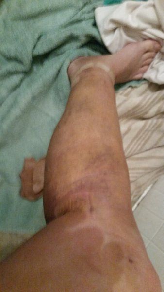 Quá trình hút mỡ bắp chân và mắt cá chân