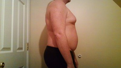 Hút mỡ cho nam giới: quý ông 40 tuổi với hành trình hút mỡ ngực, hai bên sườn, bụng, lưng