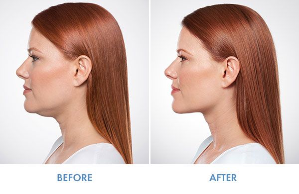 tiem kybella 1