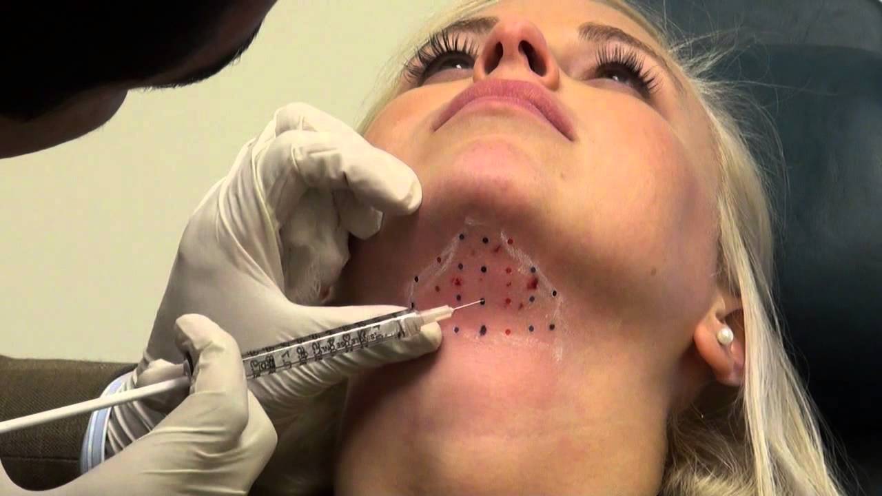 tiem kybella