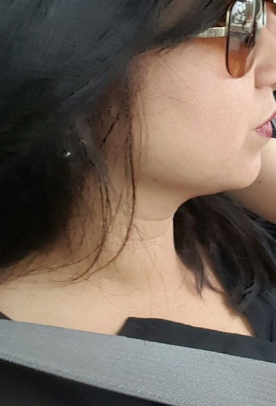 Liệu trình điều trị nâng cơ trẻ hóa da Ultherapy ở vùng cằm và vùng mặt dưới của bà mẹ 36 tuổi