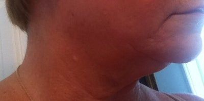 Ultherapy – Tất cả chỉ phụ thuộc vào việc lựa chọn chuyên gia điều trị tốt nhất!