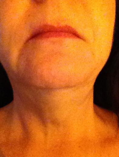 Người phụ nữ 58 tuổi với kết quả điều trị Ultherapy ngoài mong đợi