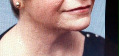 Ultherapy – Tất cả chỉ phụ thuộc vào việc lựa chọn chuyên gia điều trị tốt nhất!