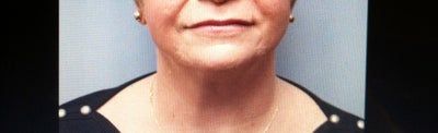 Ultherapy – Tất cả chỉ phụ thuộc vào việc lựa chọn chuyên gia điều trị tốt nhất!