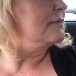 Kết quả bất ngờ từ liệu trình Ultherapy nâng cơ trẻ hóa vùng mặt dưới cho người phụ nữ 53 tuổi