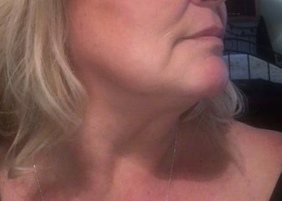 Kết quả bất ngờ từ liệu trình Ultherapy nâng cơ trẻ hóa vùng mặt dưới cho người phụ nữ 53 tuổi