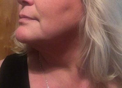 Kết quả bất ngờ từ liệu trình Ultherapy nâng cơ trẻ hóa vùng mặt dưới cho người phụ nữ 53 tuổi
