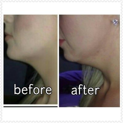 Tiêm Kybella xóa nọng cằm di truyền ở cô gái 27 tuổi