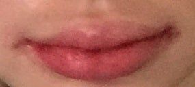 Hành trình cấy mỡ tự thân vào môi, “biến hóa” đôi môi mỏng trở nên căng mọng đầy sức sống