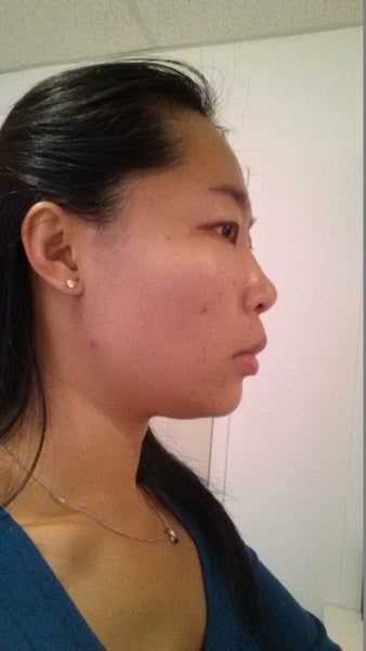 Khuôn mặt thon gọn, đường viền hàm rõ nét sau 3 lần làm Ultherapy