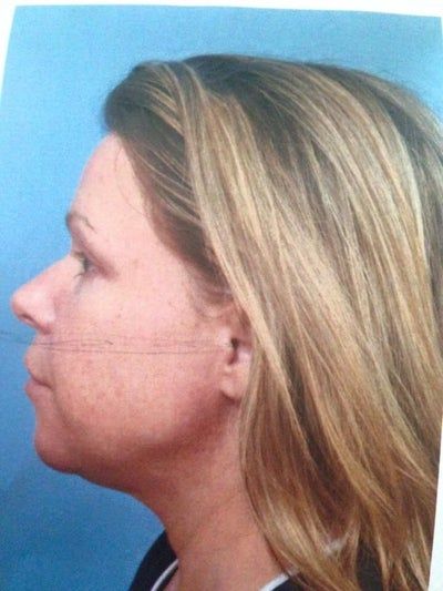 Mẹ 2 con với liệu trình điều trị Ultherapy cho vùng dưới khuôn mặt, đường viền hàm/dưới cằm
