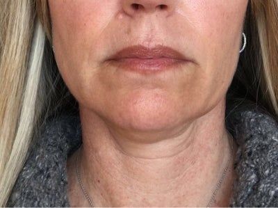 Hạnh phúc của người phụ nữ 52 tuổi đánh tan nọng cằm chỉ sau 1 lần tiêm Kybella