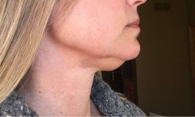 Hạnh phúc của người phụ nữ 52 tuổi đánh tan nọng cằm chỉ sau 1 lần tiêm Kybella