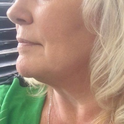 Kết quả bất ngờ từ liệu trình Ultherapy nâng cơ trẻ hóa vùng mặt dưới cho người phụ nữ 53 tuổi