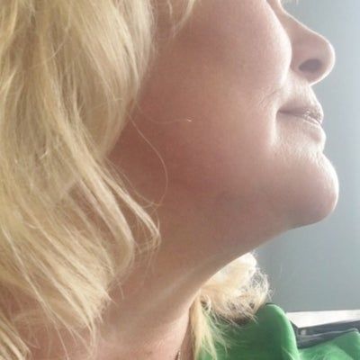 Kết quả bất ngờ từ liệu trình Ultherapy nâng cơ trẻ hóa vùng mặt dưới cho người phụ nữ 53 tuổi