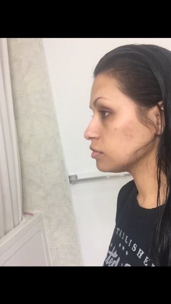Quá trình tiêm Kybella điêu khắc vùng hàm và loại bỏ túi mỡ thừa lỏng lẻo dưới cằm