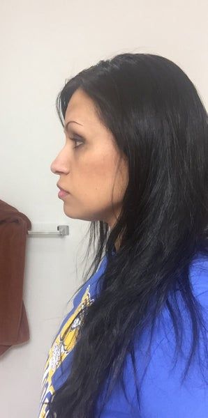 Quá trình tiêm Kybella điêu khắc vùng hàm và loại bỏ túi mỡ thừa lỏng lẻo dưới cằm