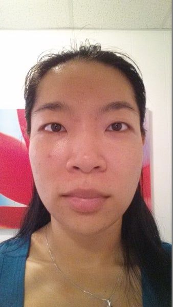 Khuôn mặt thon gọn, đường viền hàm rõ nét sau 3 lần làm Ultherapy