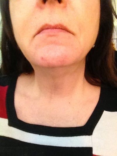 Người phụ nữ 58 tuổi với kết quả điều trị Ultherapy ngoài mong đợi