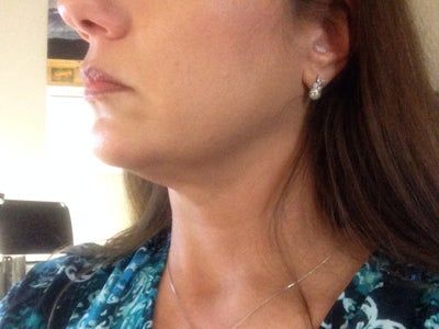 Liệu trình làm Ultherapy cho toàn bộ vùng mặt và vùng cổ trên