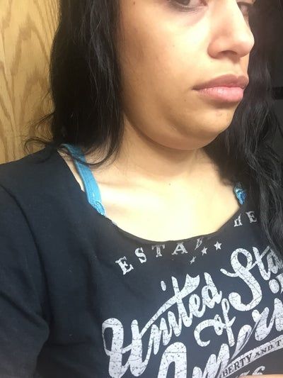 Quá trình tiêm Kybella điêu khắc vùng hàm và loại bỏ túi mỡ thừa lỏng lẻo dưới cằm