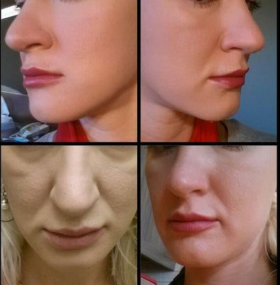 Hành trình cấy mỡ tự thân giúp cô gái thay đổi khuôn mặt gầy không cân đối vì nằm nghiêng một bên quá nhiều