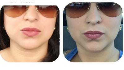 Liệu trình điều trị nâng cơ trẻ hóa da Ultherapy ở vùng cằm và vùng mặt dưới của bà mẹ 36 tuổi