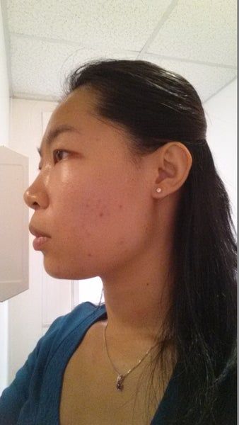 Khuôn mặt thon gọn, đường viền hàm rõ nét sau 3 lần làm Ultherapy