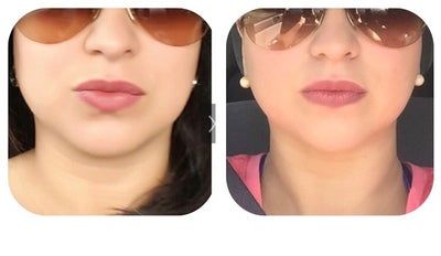 Liệu trình điều trị nâng cơ trẻ hóa da Ultherapy ở vùng cằm và vùng mặt dưới của bà mẹ 36 tuổi