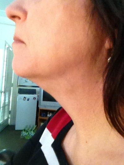 Người phụ nữ 58 tuổi với kết quả điều trị Ultherapy ngoài mong đợi