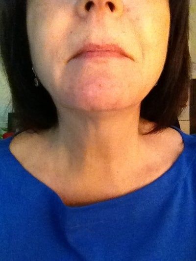 Người phụ nữ 58 tuổi với kết quả điều trị Ultherapy ngoài mong đợi