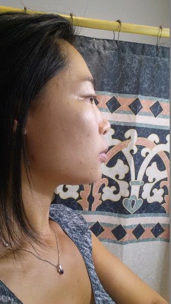 Khuôn mặt thon gọn, đường viền hàm rõ nét sau 3 lần làm Ultherapy