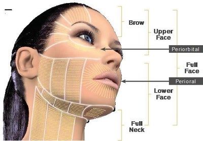 Mẹ 2 con với liệu trình điều trị Ultherapy cho vùng dưới khuôn mặt, đường viền hàm/dưới cằm