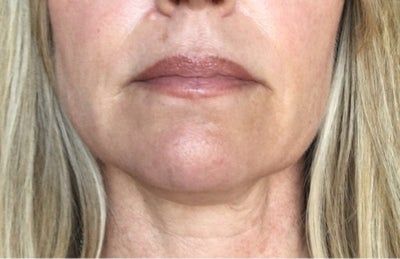 Hạnh phúc của người phụ nữ 52 tuổi đánh tan nọng cằm chỉ sau 1 lần tiêm Kybella
