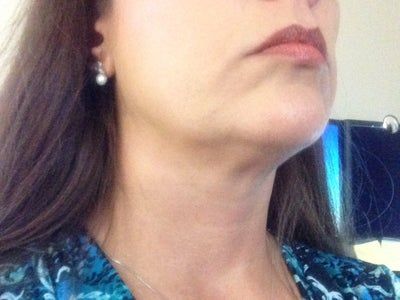 Liệu trình làm Ultherapy cho toàn bộ vùng mặt và vùng cổ trên
