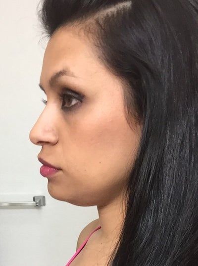 Quá trình tiêm Kybella điêu khắc vùng hàm và loại bỏ túi mỡ thừa lỏng lẻo dưới cằm