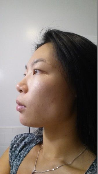 Khuôn mặt thon gọn, đường viền hàm rõ nét sau 3 lần làm Ultherapy