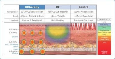 Mẹ 2 con với liệu trình điều trị Ultherapy cho vùng dưới khuôn mặt, đường viền hàm/dưới cằm